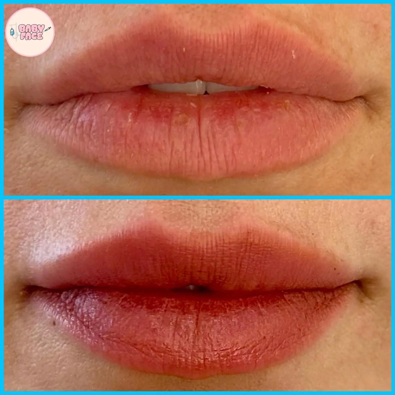 Dermal Filler