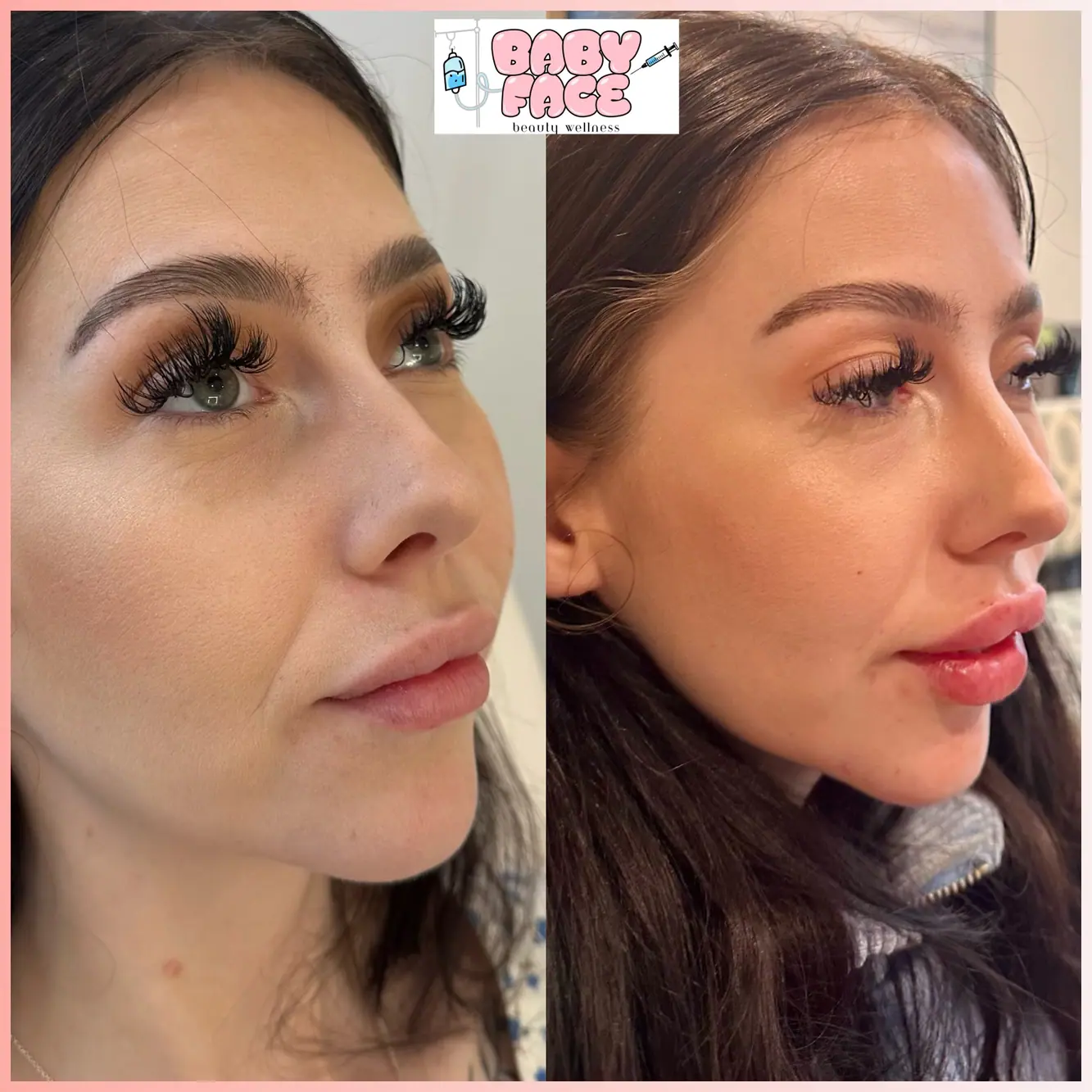 Dermal Filler