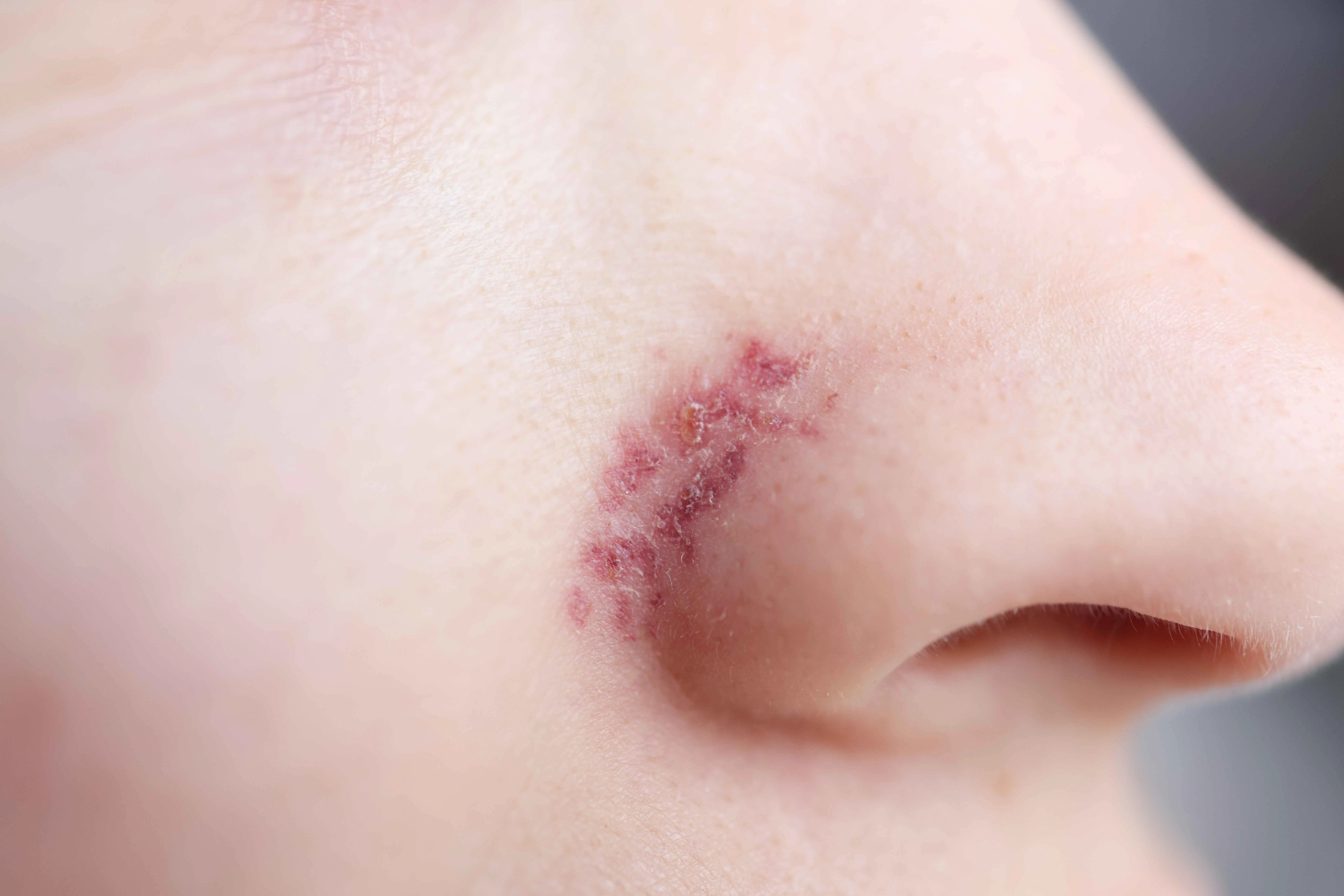 Laser Treatment for Vascular Lesions