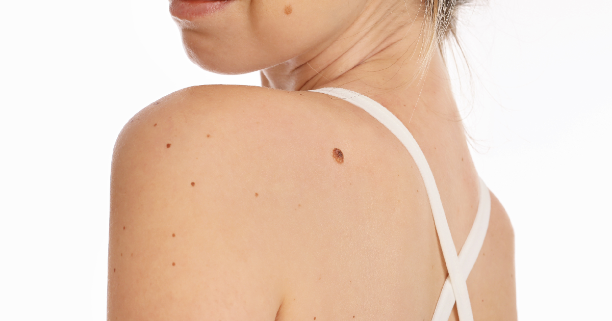 Women receiving Skin Tag Removal in Costa Mesa, CA