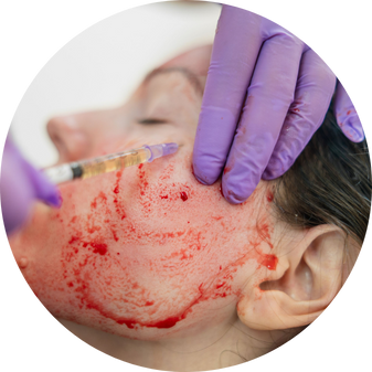 a person getting a PLATELET RICH FIBRIN injection