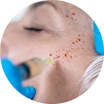 Platelet Rich Fibrin