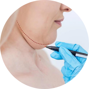 Kybella