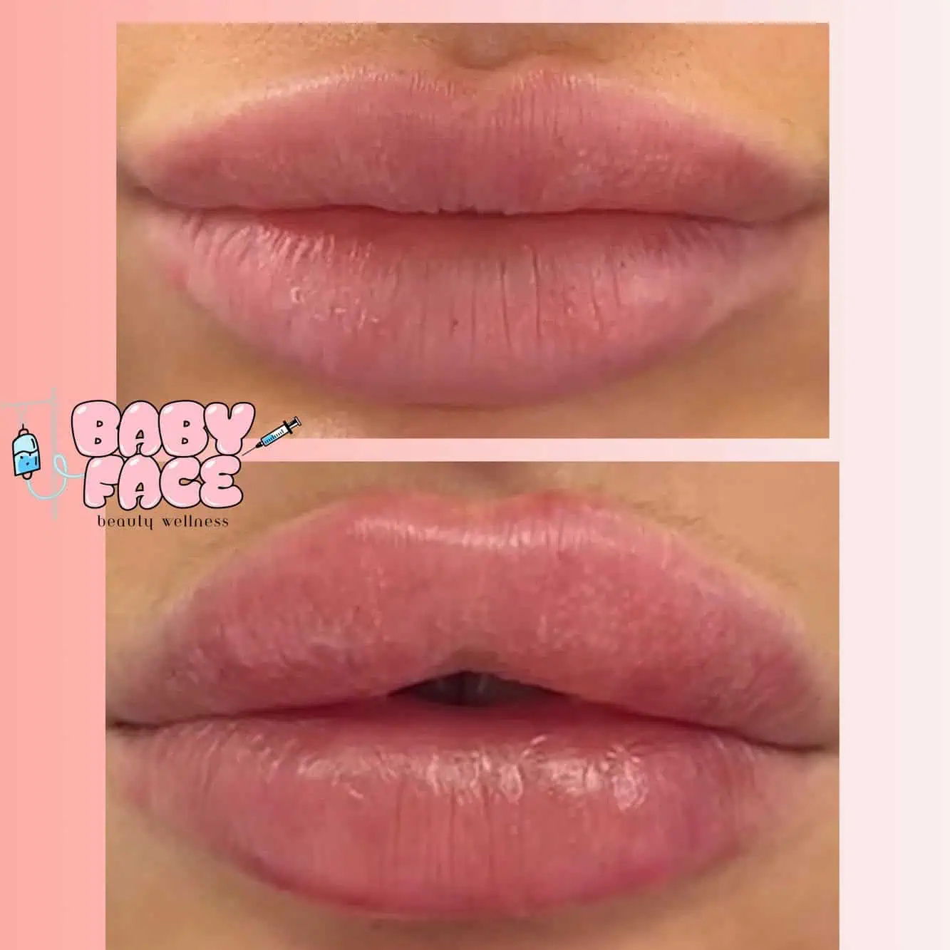 Lip Filler Before & After