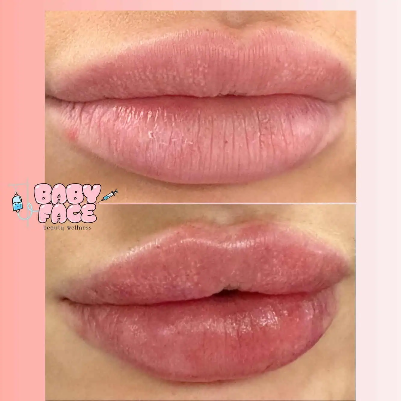 Lip Filler Before & After