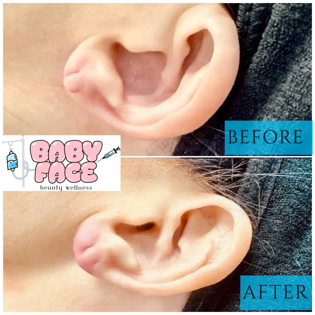 Earlobe Filler