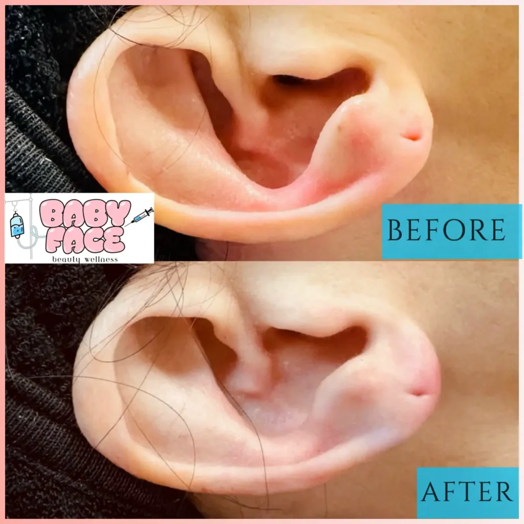 Earlobe Filler
