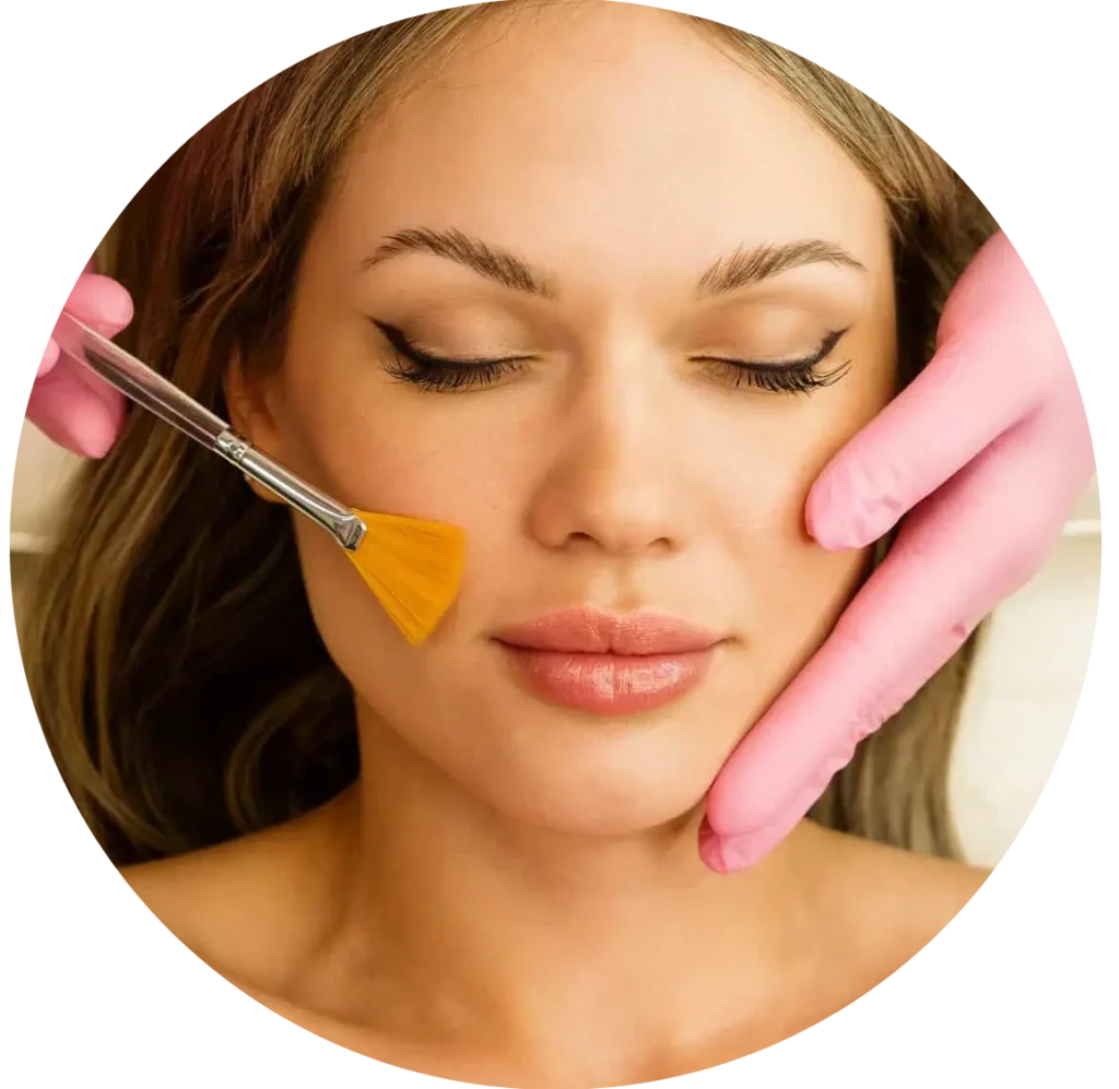 Microneedling with VI Peel