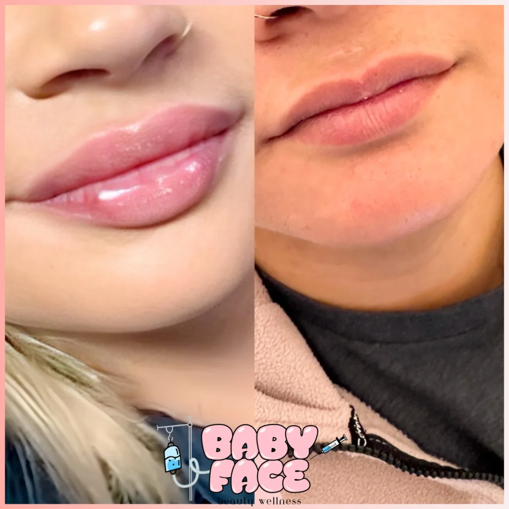 LIP FILLER BEFORE AND AFTER