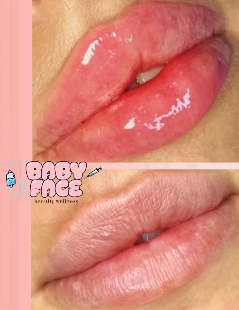 LIP FILLER BEFORE AND AFTER PHOTO