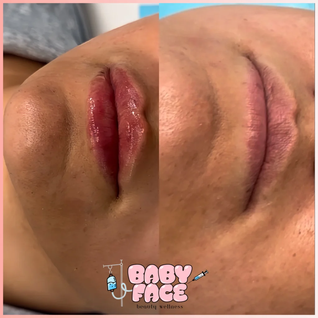 LIP FILLER BEFORE AND AFTER