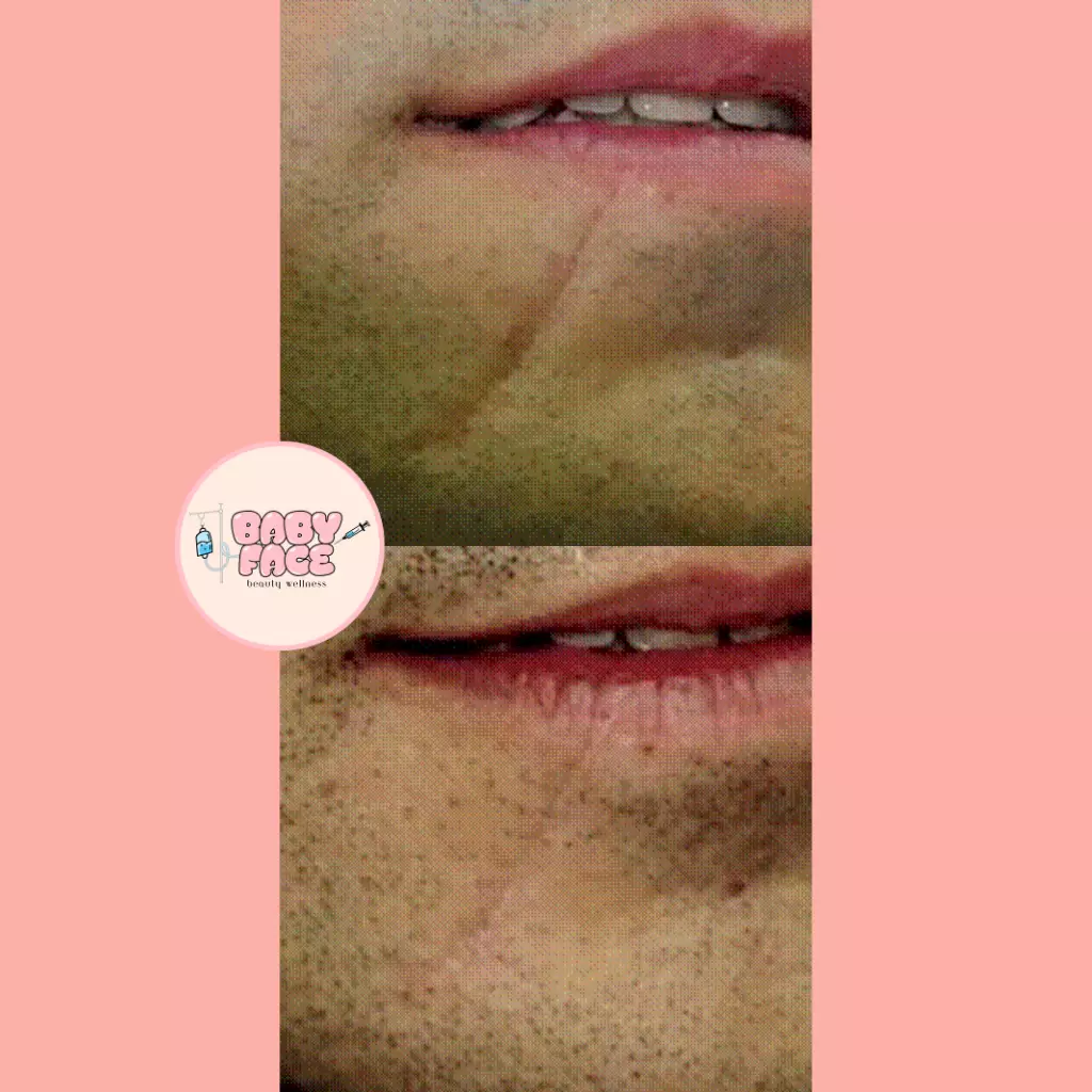 Before & After Laser Scar Revision