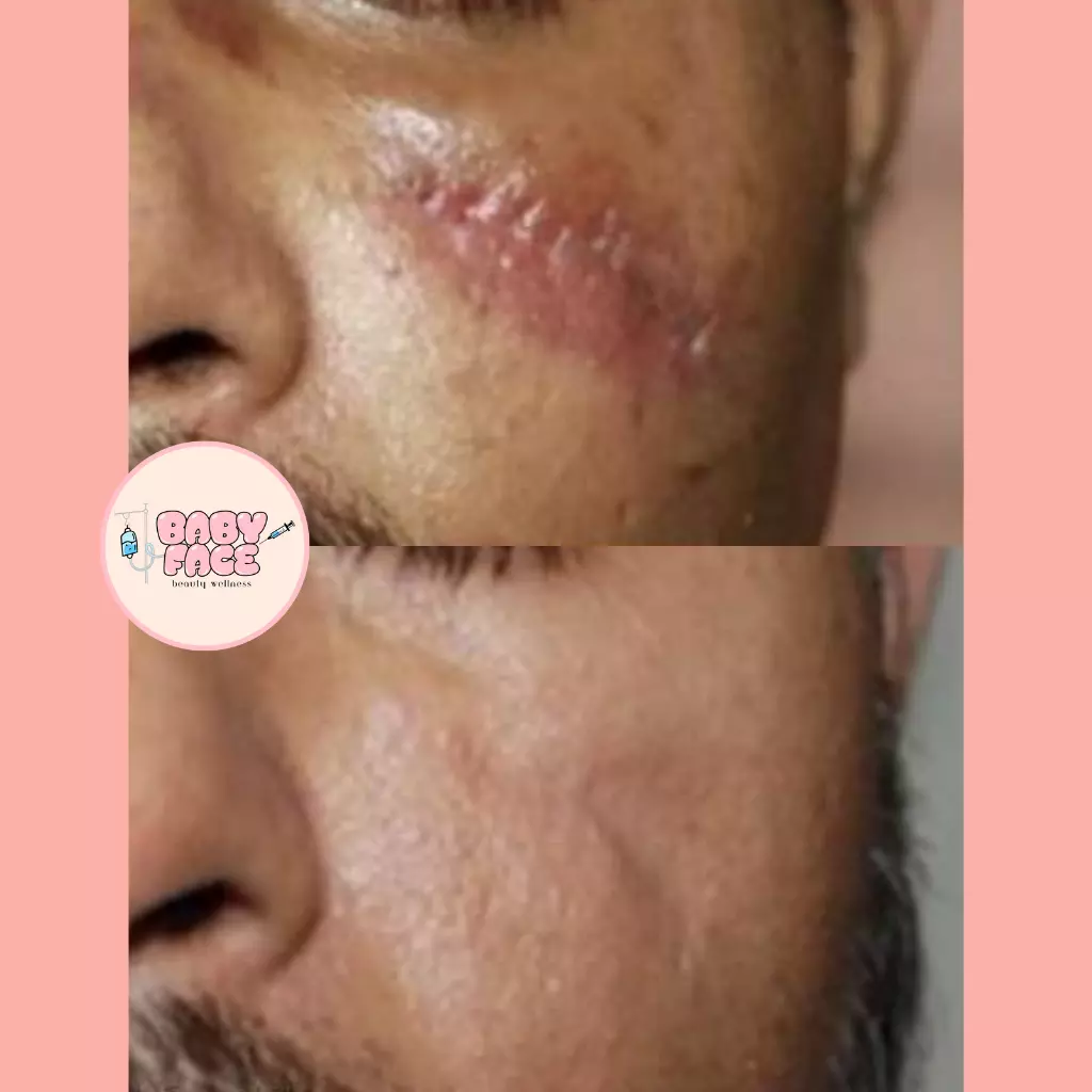 Before & After Laser Scar Revision