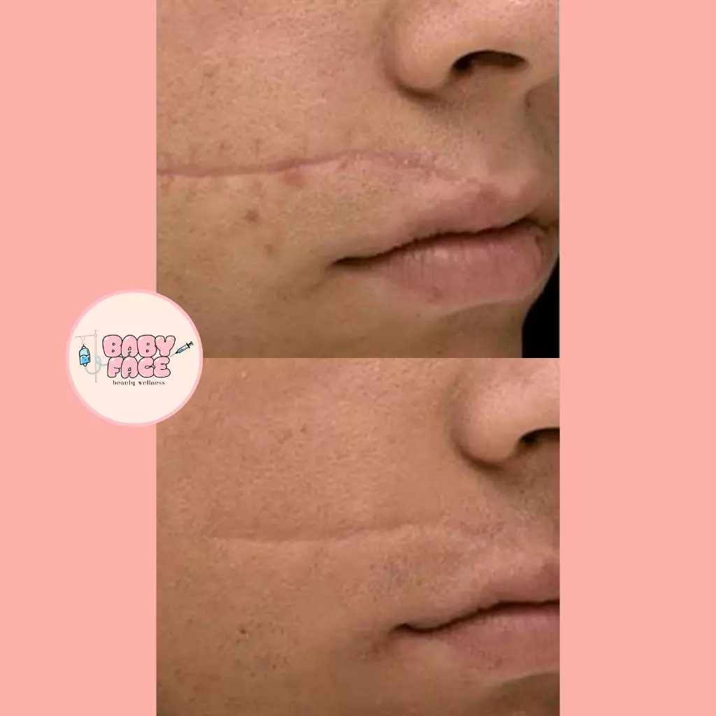 Before & After Laser Scar Revision