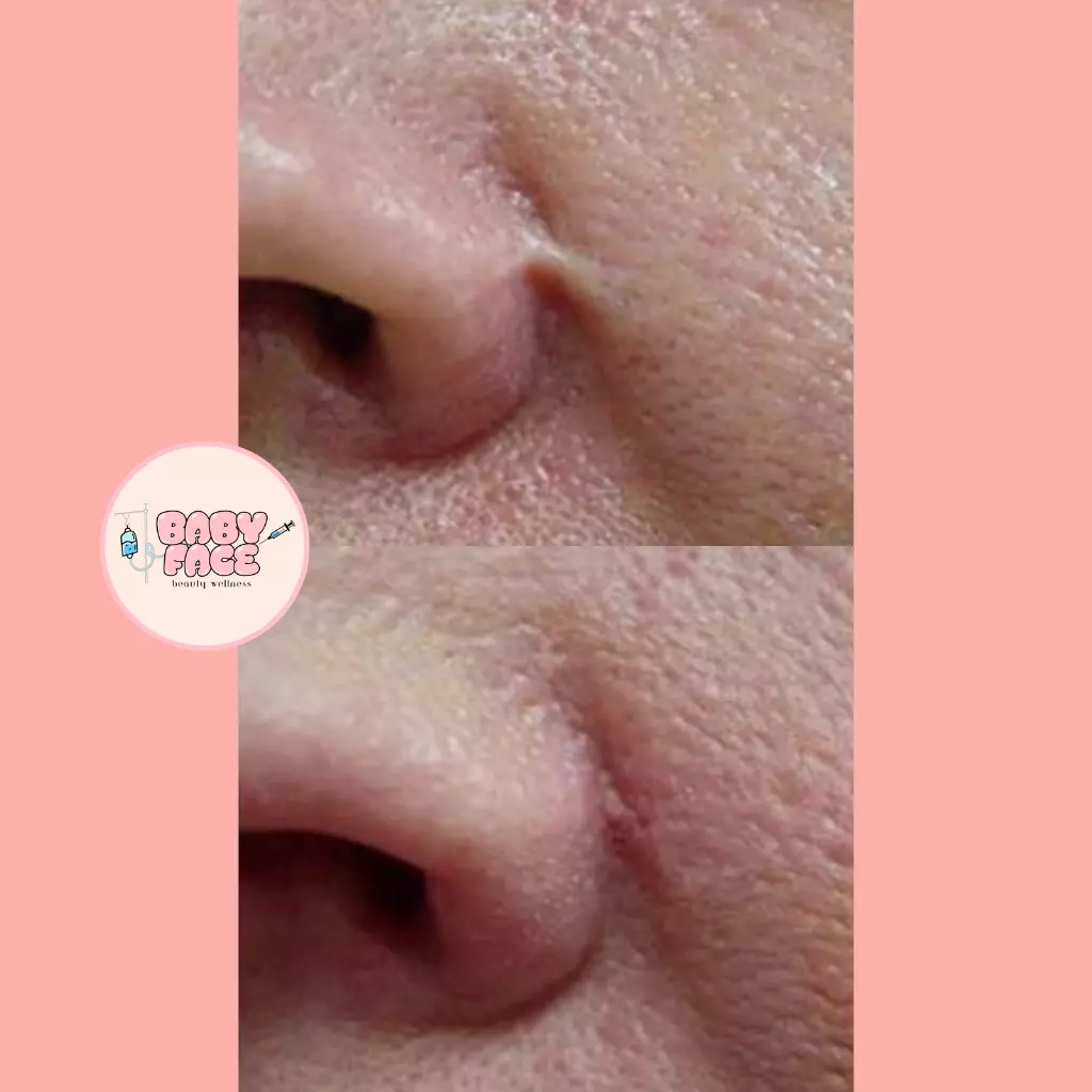 Before & After Laser Scar Revision