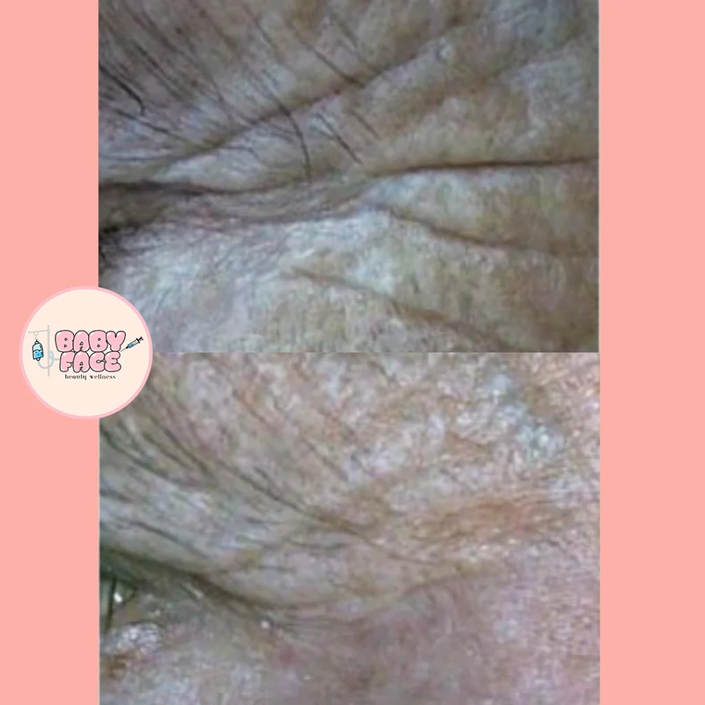 Before & After Fotona Fractional Laser Skin Resurfacing Treatment