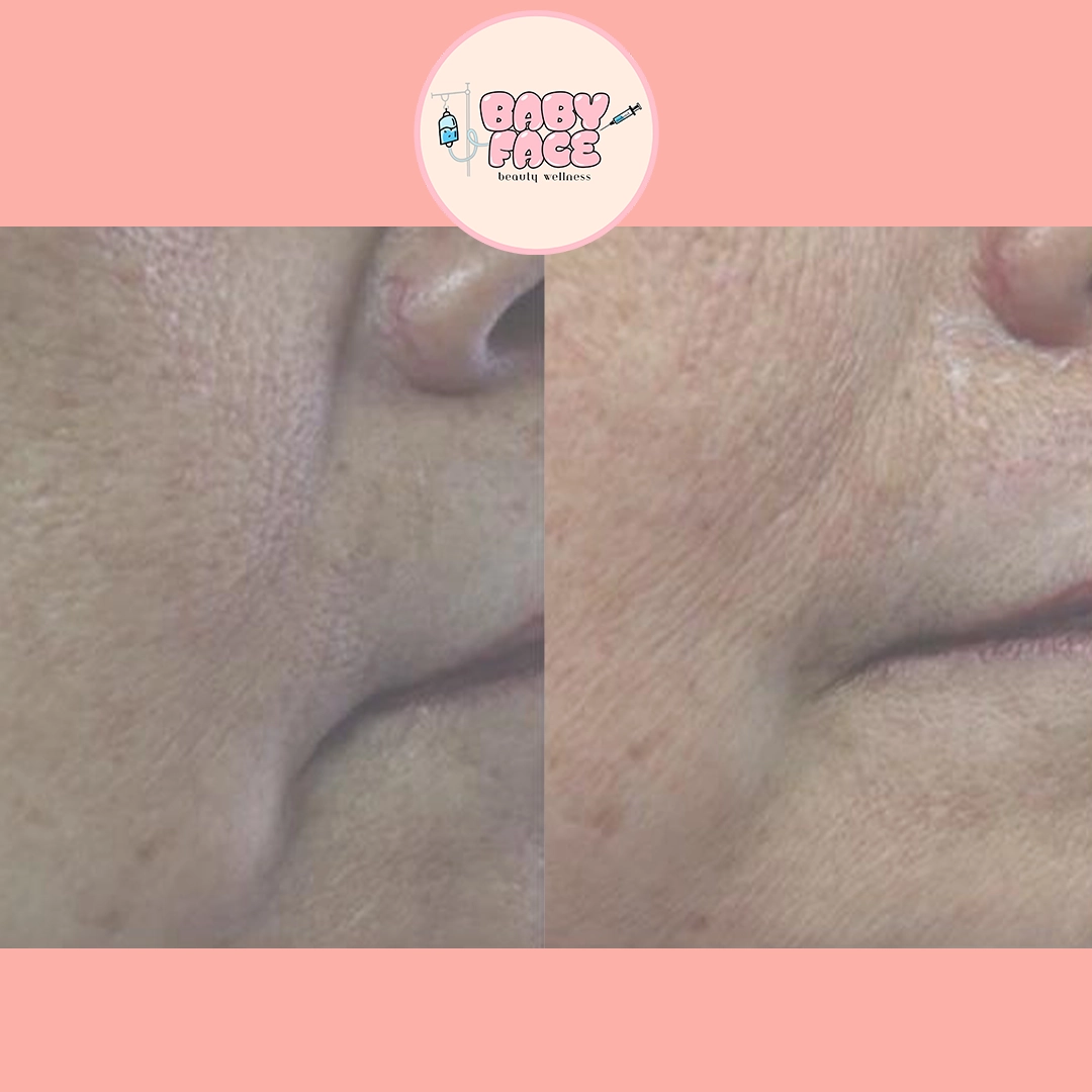 Fotona 4D Facelift before & after cheek treatment result