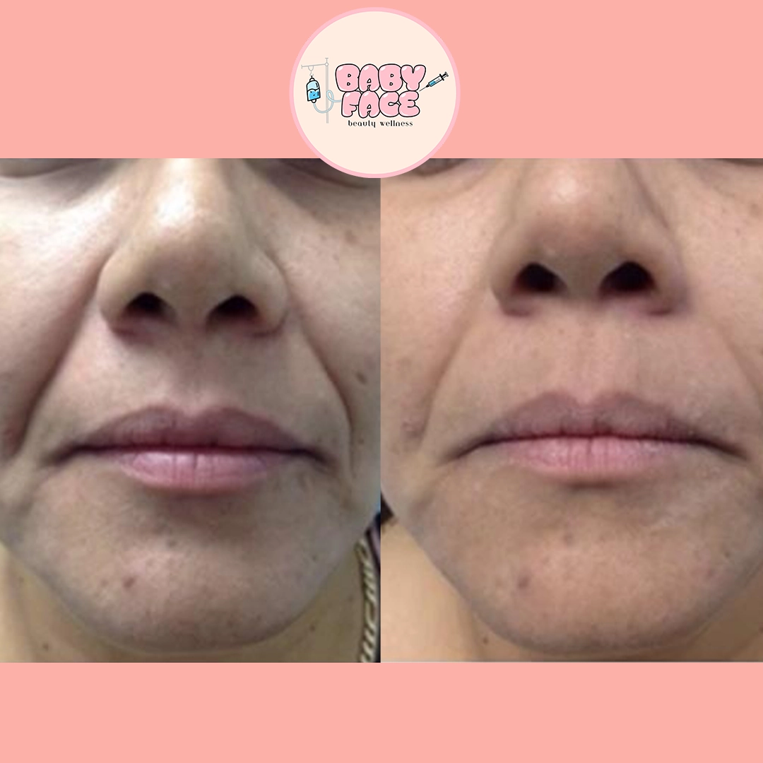 Fotona 4D Facelift before & after lip treatment result