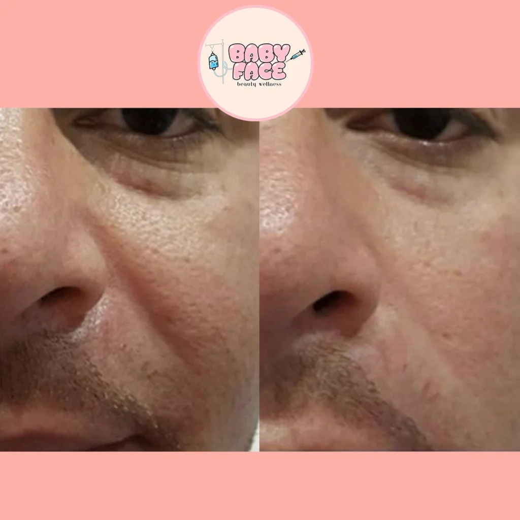 Fotona 4D Facelift before & after cheek treatment result