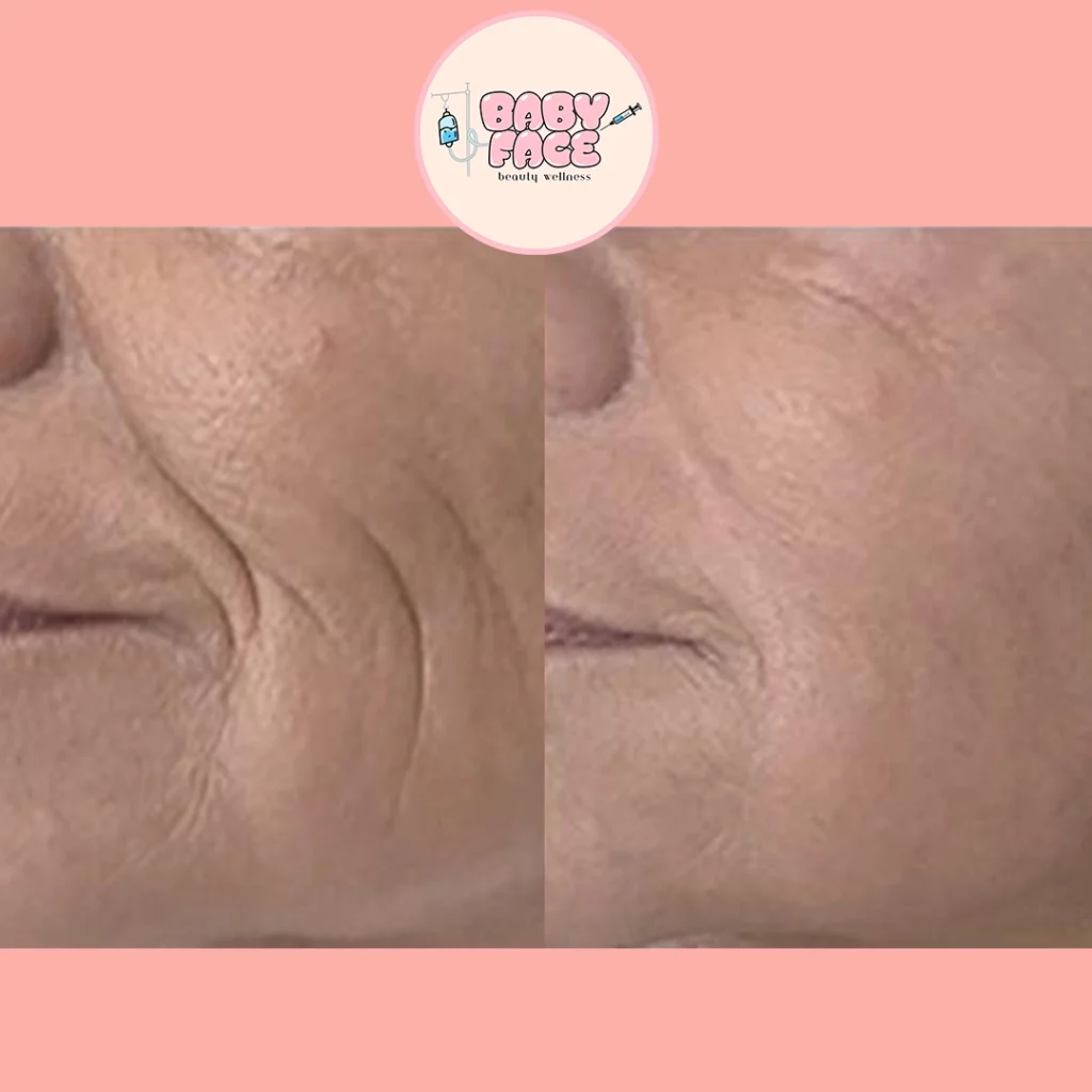 Fotona 4D Facelift before & after cheek treatment result