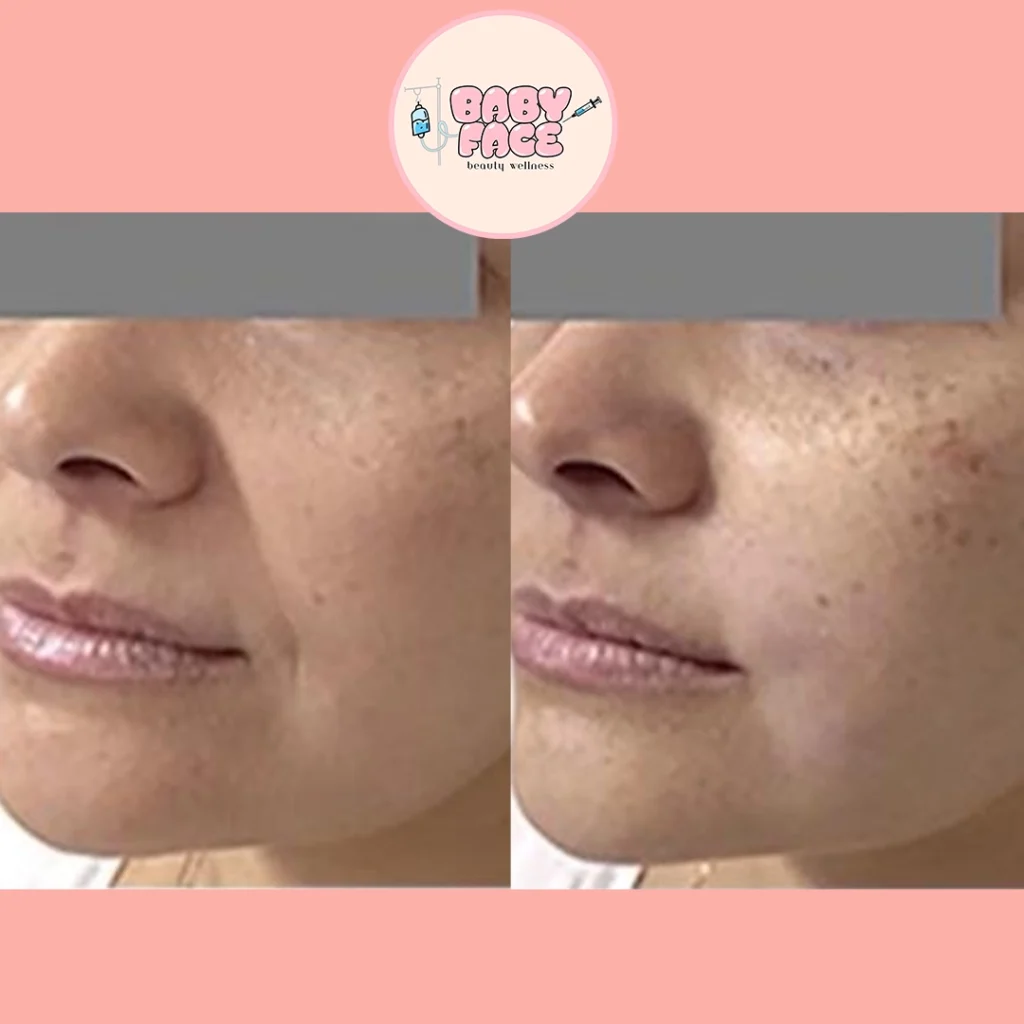 Fotona 4D Facelift before & after cheek treatment result