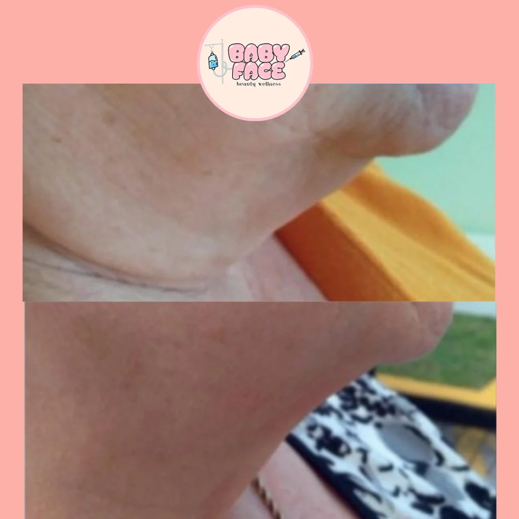 Before & After Fotona 4D Neck Lift