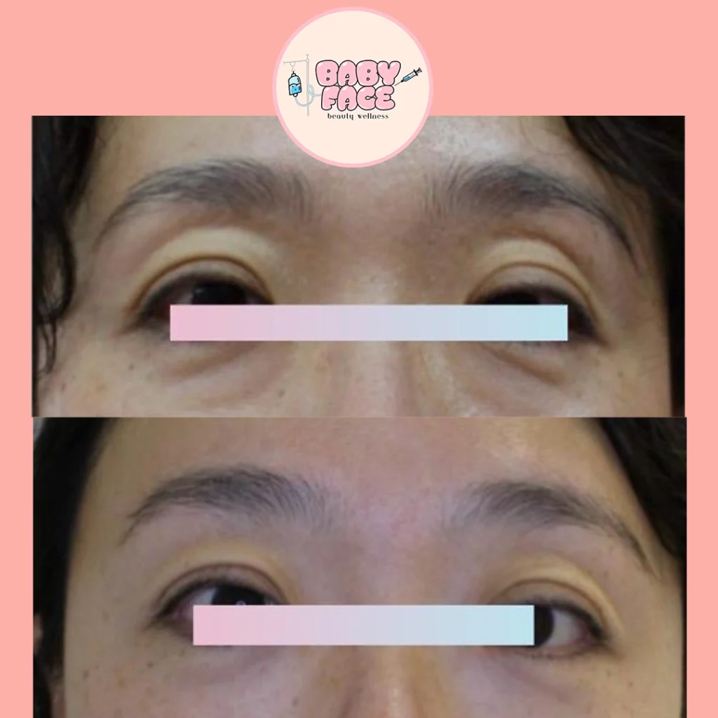 Fotona 4D before & after eye treatment result