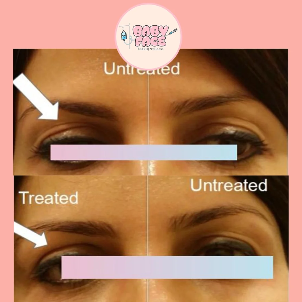 Fotona before & after eye treatment result