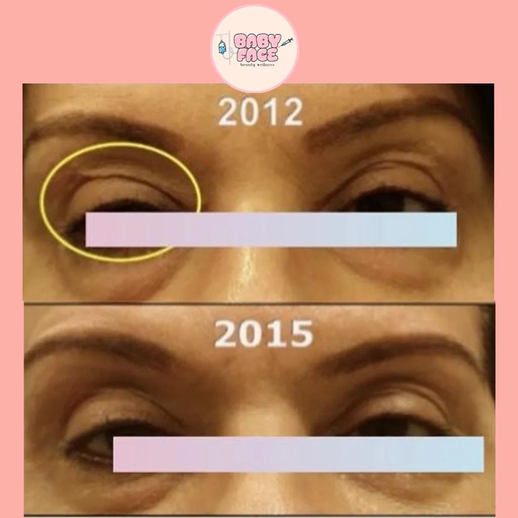 Fotona before & after eye treatment result