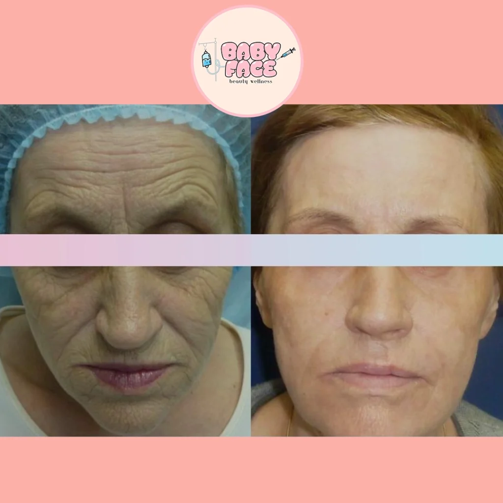 Before & After Fotona Full-Field Skin Resurfacing