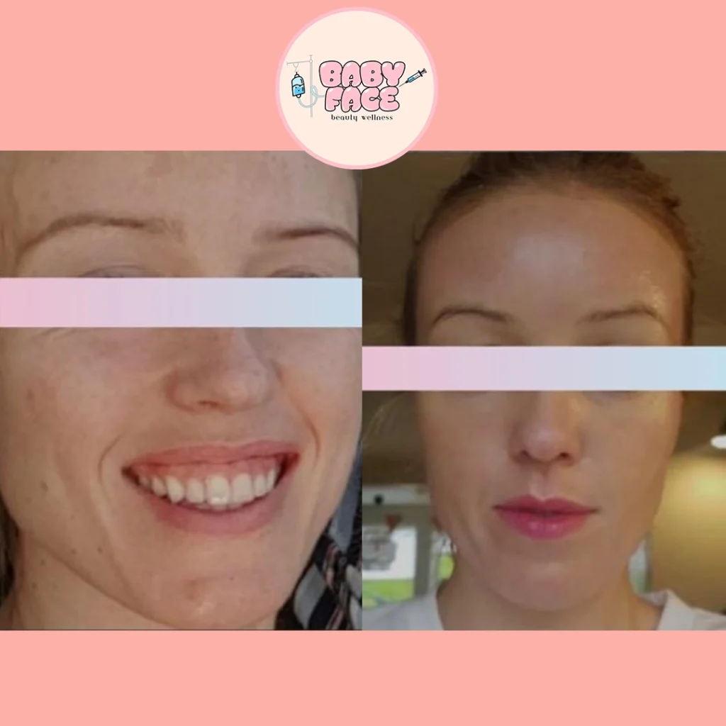 Before & After Fotona Full-Field Skin Resurfacing