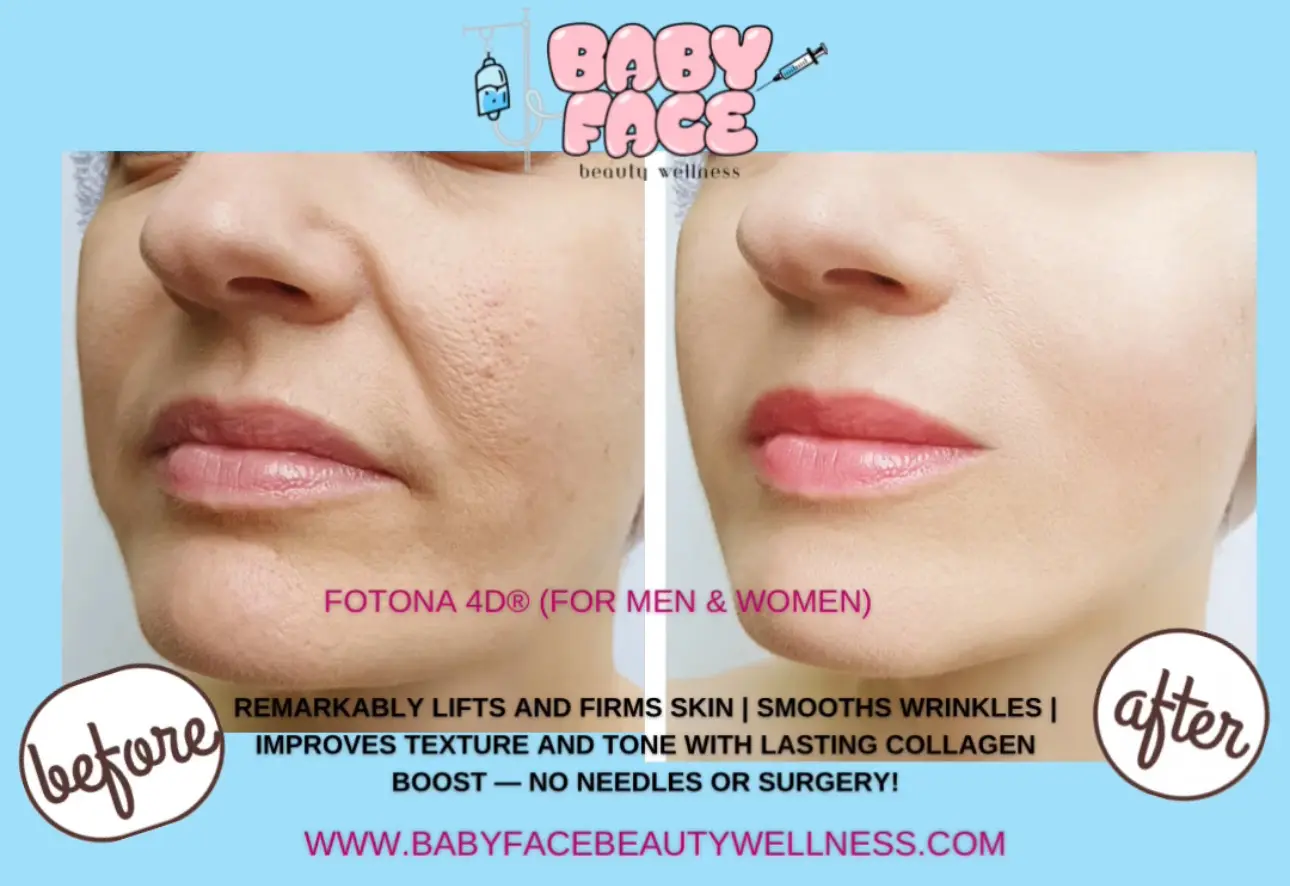 Before & after Fotona 4D Facelift treatment