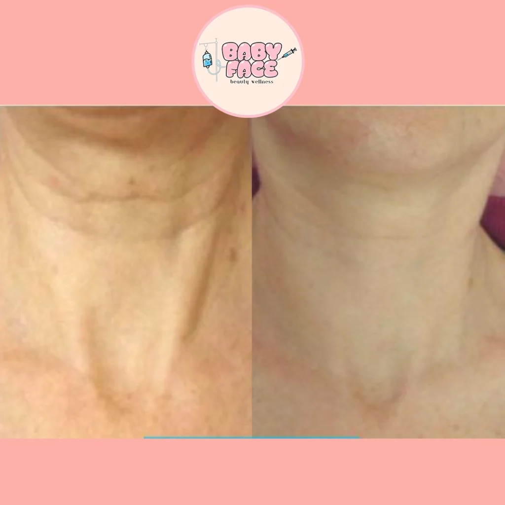 Before & After Fotona 4D Neck Lift