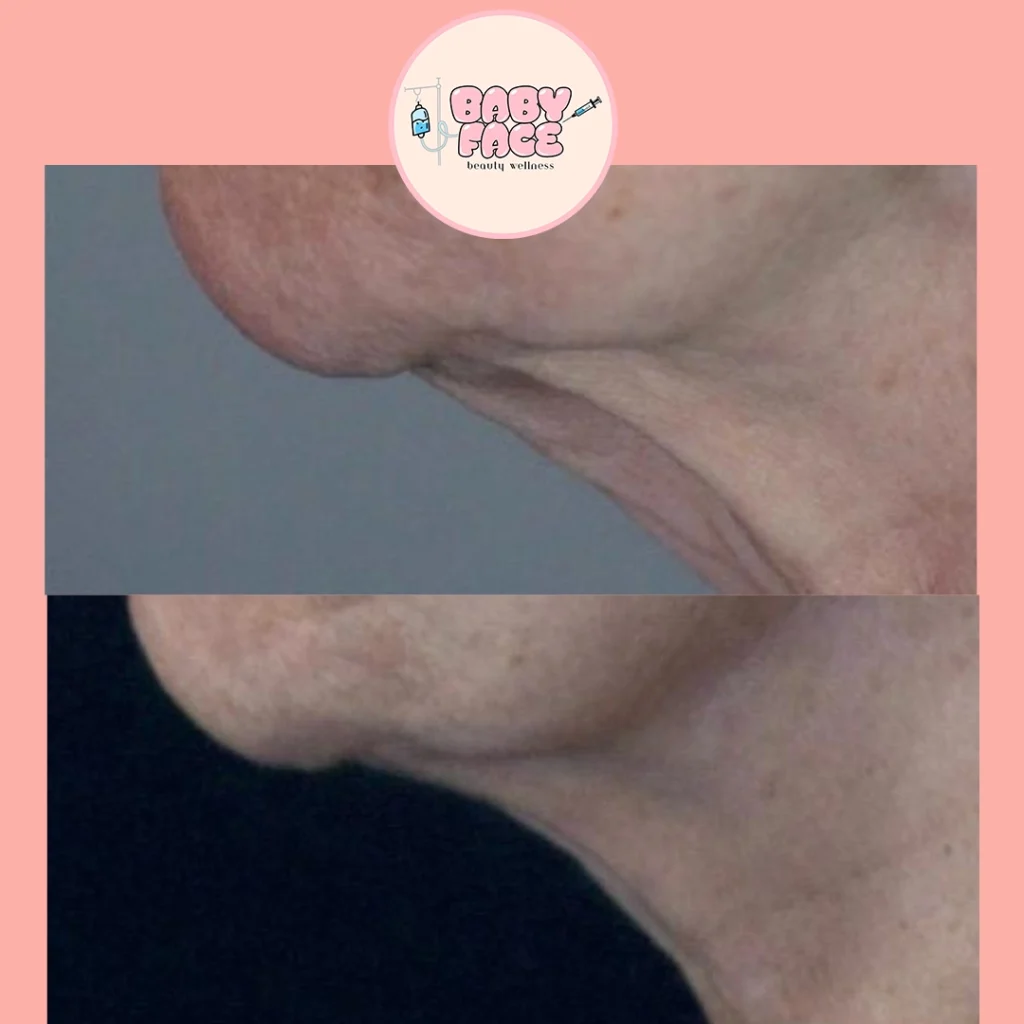 Before & After Fotona 4D Neck Lift