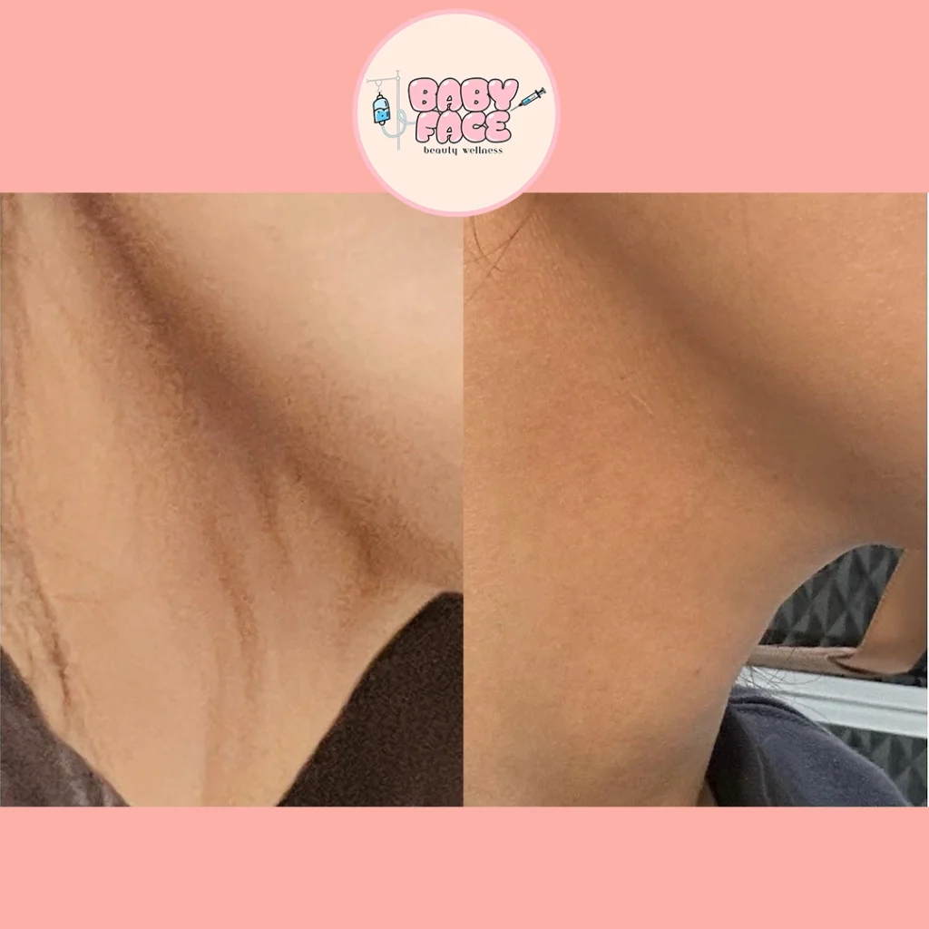 Before & After Fotona 4D Neck Lift