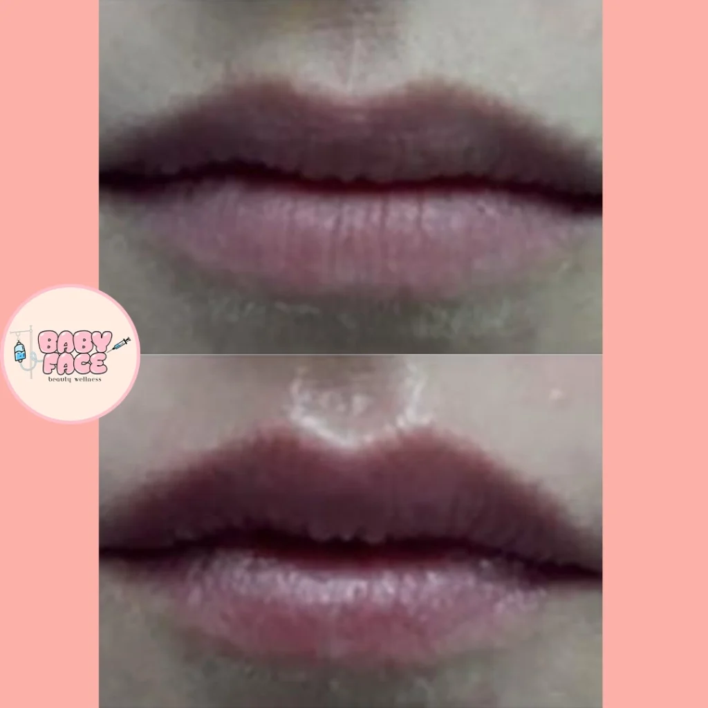 Before & After Fotona Liplase Treatment