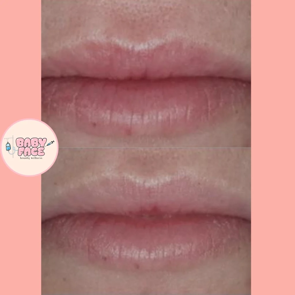 Before & After Fotona Liplase Treatment