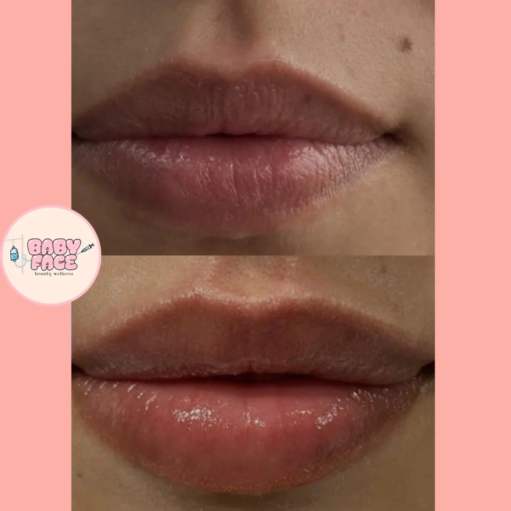Before & After Fotona Liplase Treatment