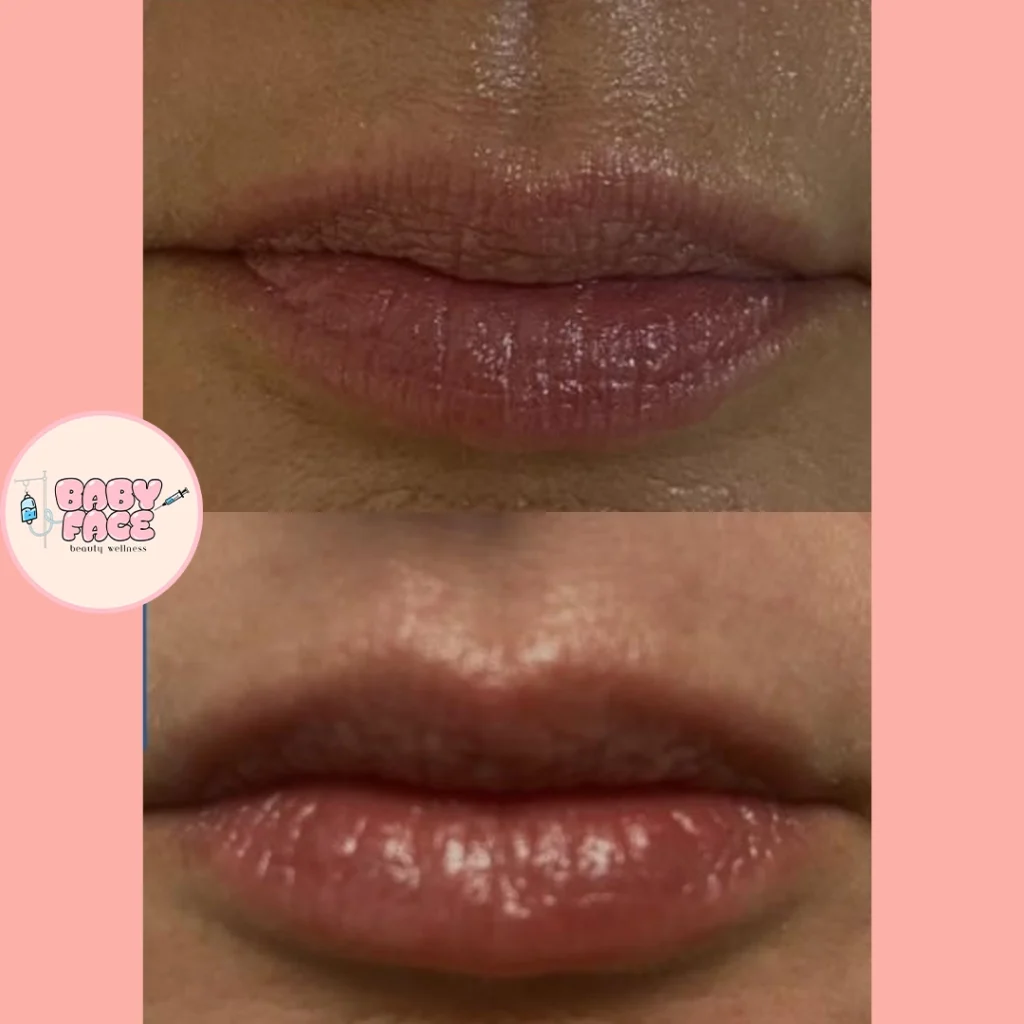 Before & After Fotona Liplase Treatment