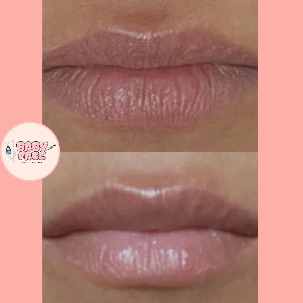 Before & After Fotona Liplase Treatment