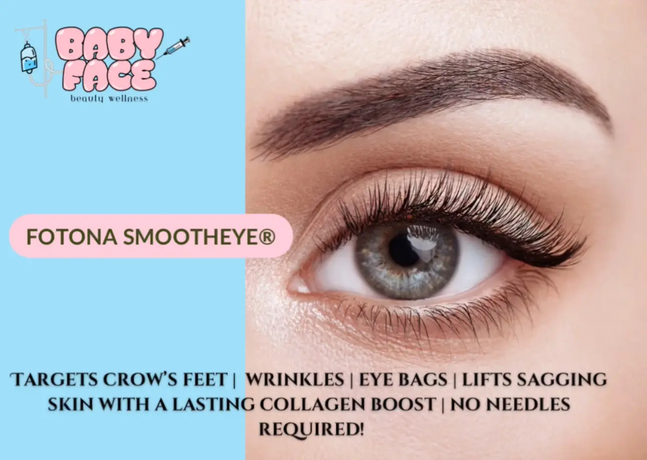 Fotona SmoothEye Laser Treatment in Costa Mesa, CA