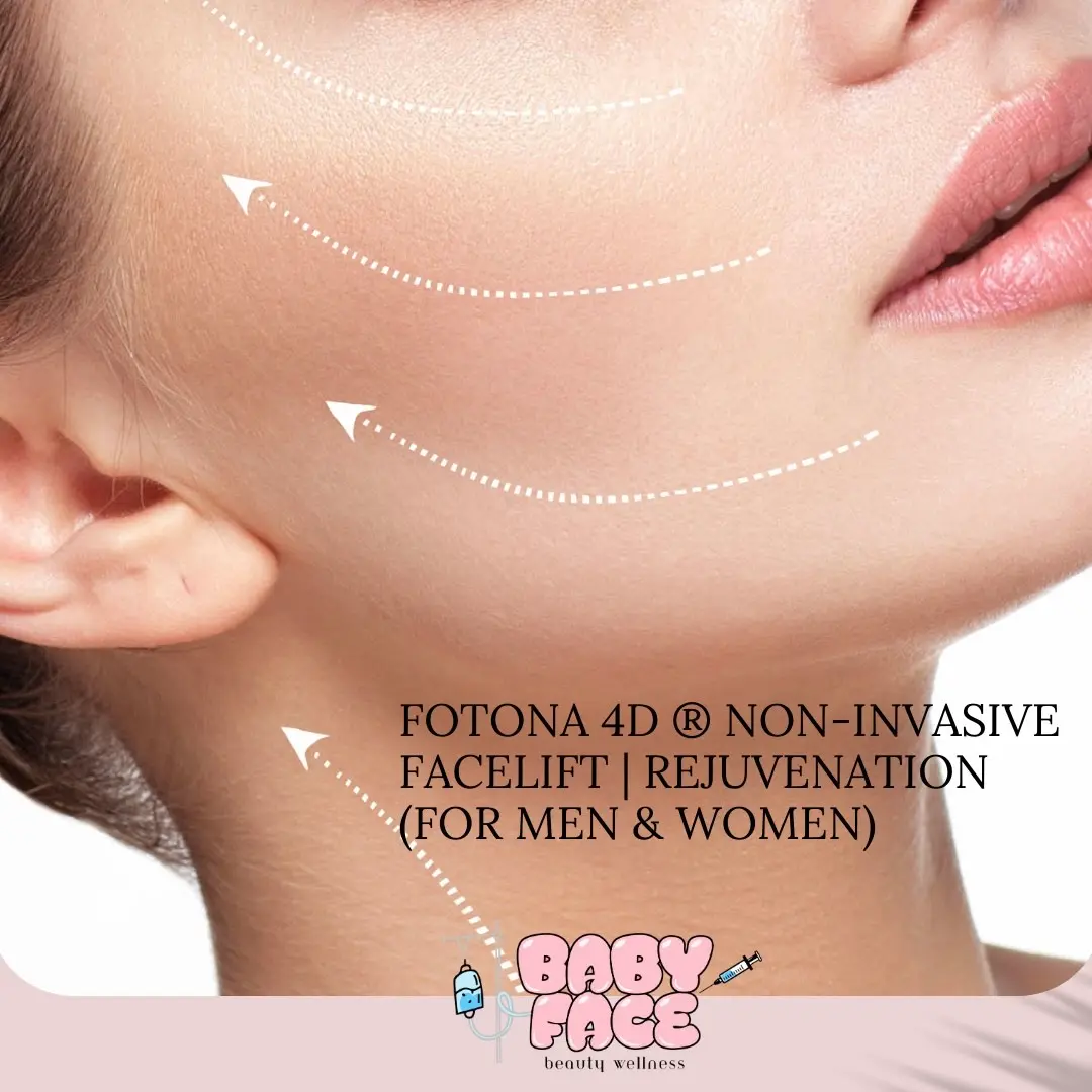 Fotona 4D Facelift for Men & Women in Costa Mesa, CA