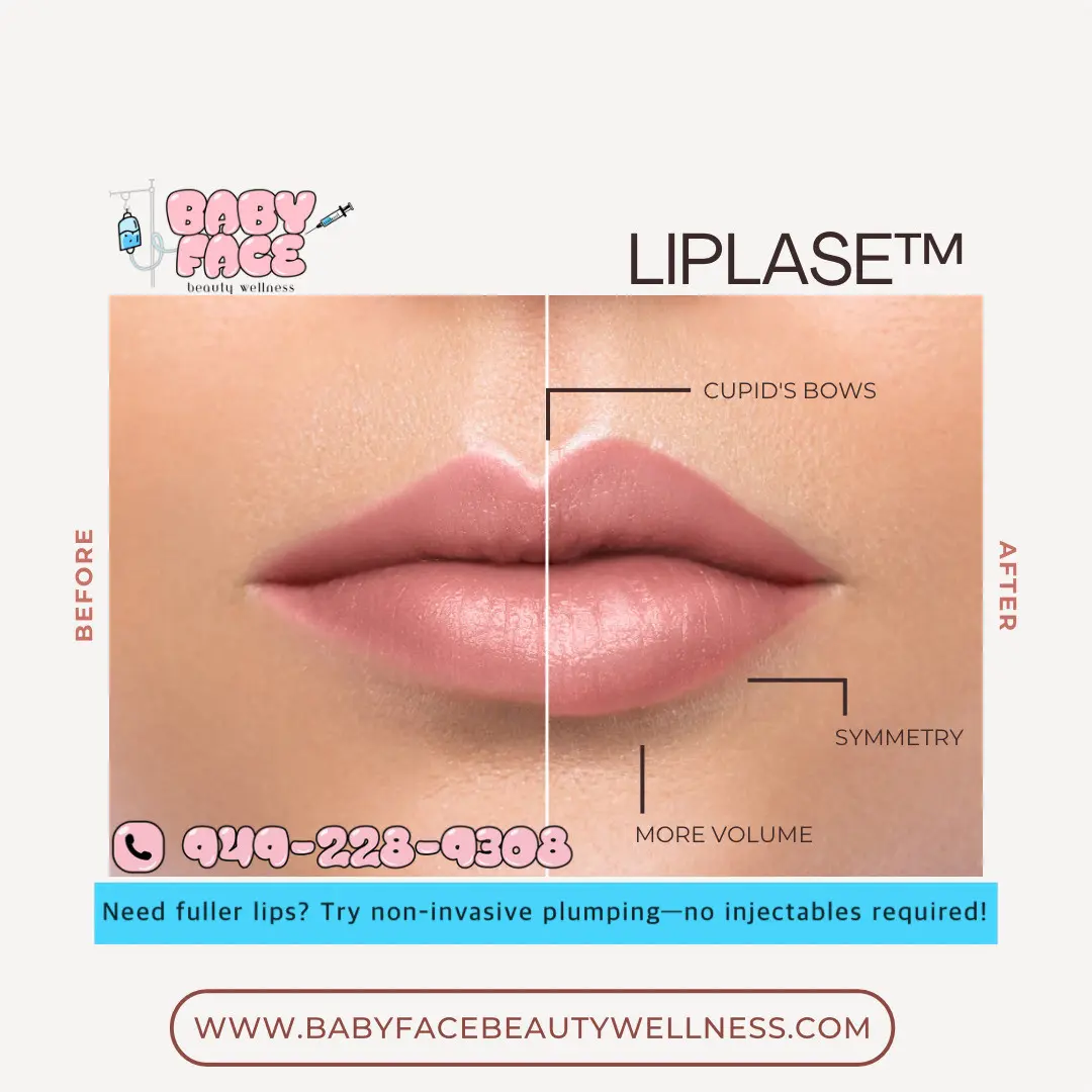 Before & After Fotona Liplase Treatment