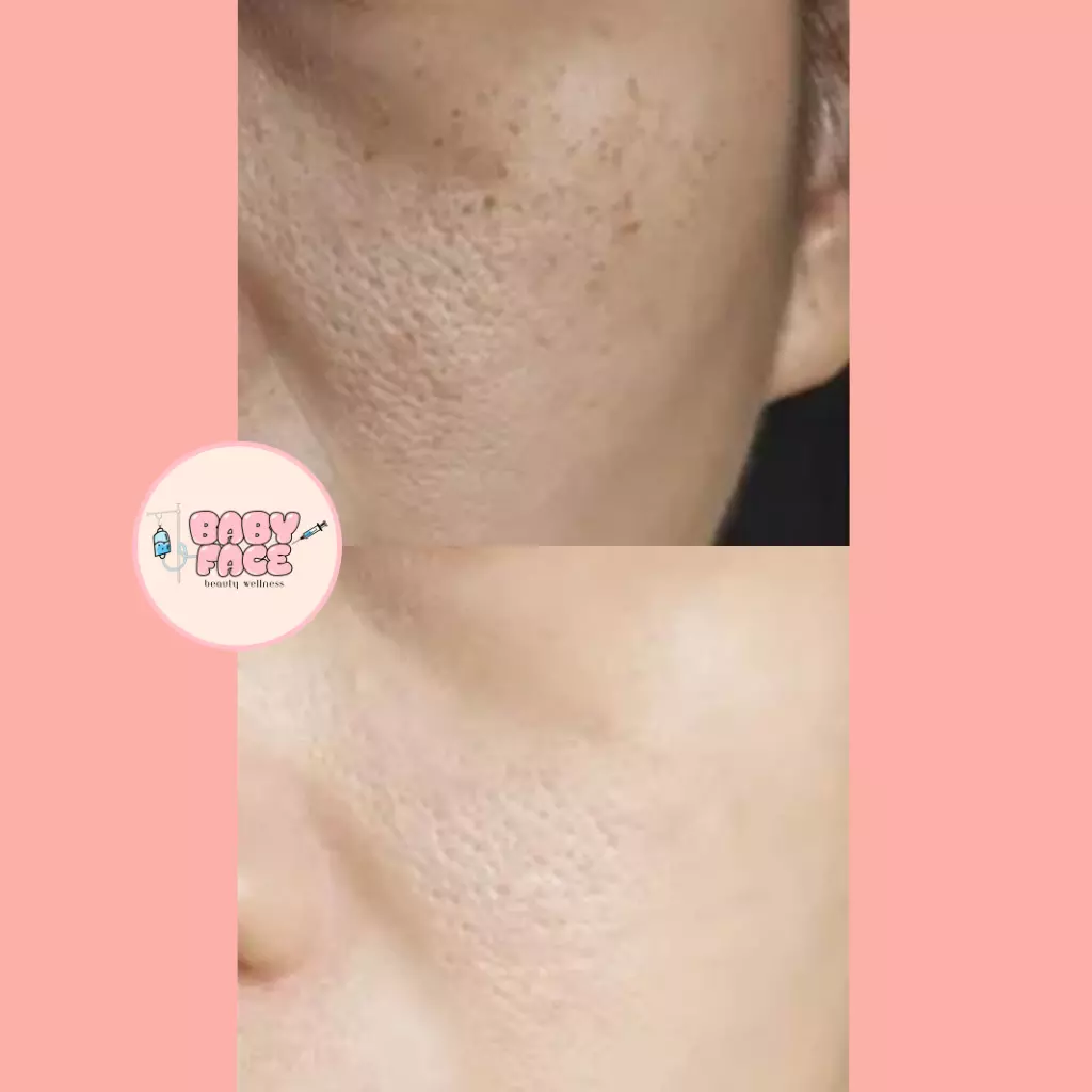 Before & After Epidermal Nevi: Mole Removal