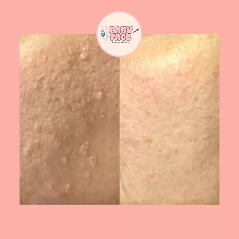 Before & After Laser Sebaceous Hyperplasia Treatment