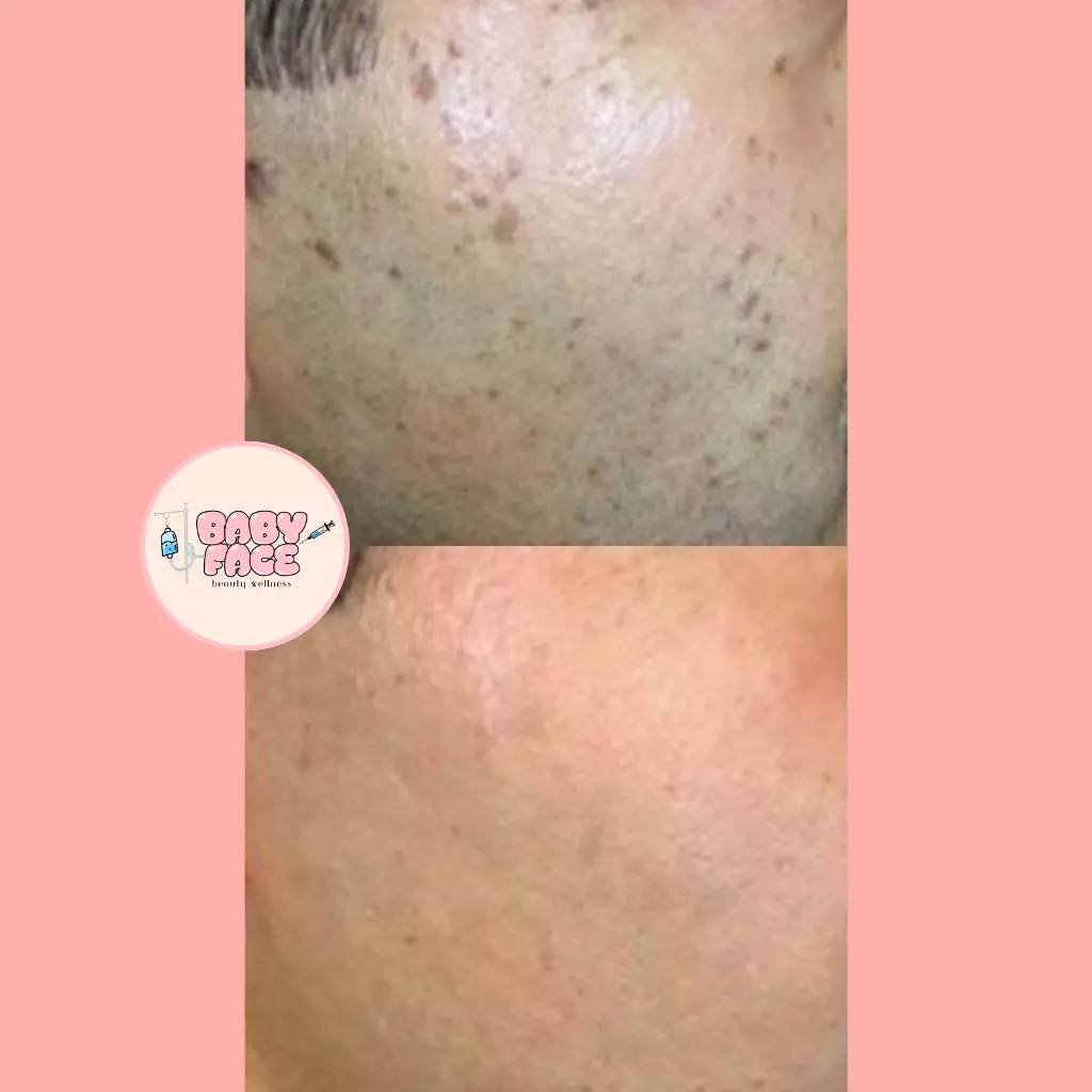 Before & After Laser Seborrheic Keratosis Treatment