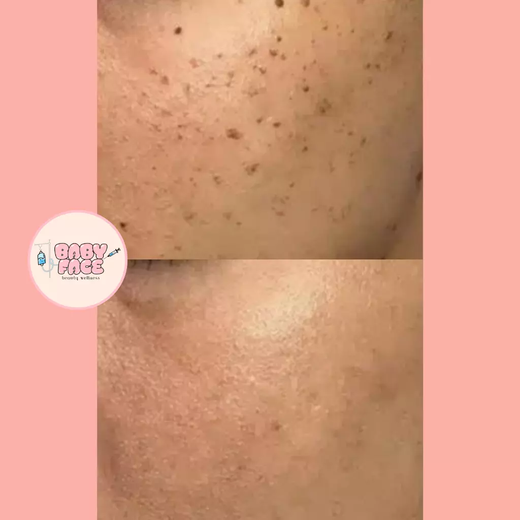 Before & After Skin Tag Removal Treatment