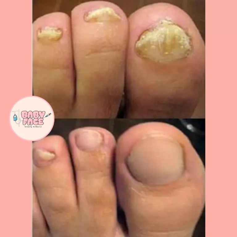 Before & After Laser Nail Fungus Treatment