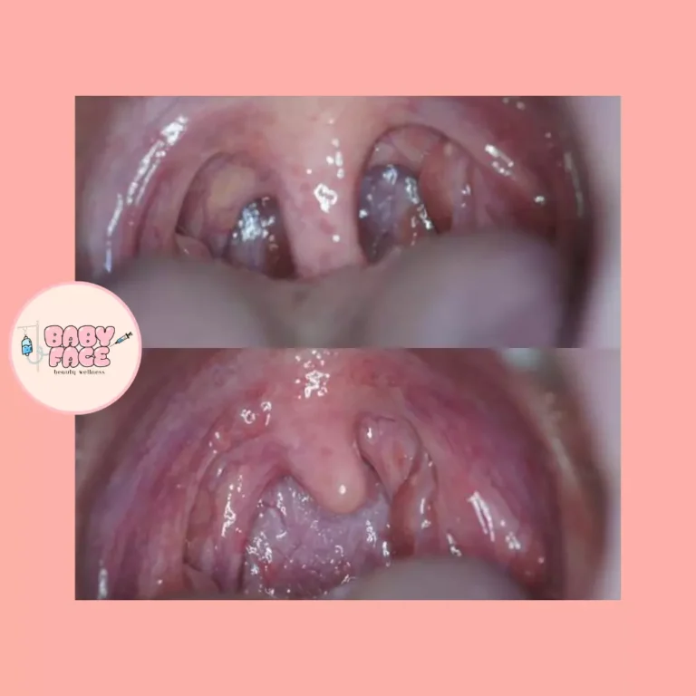 Before & After Fotona NightLase