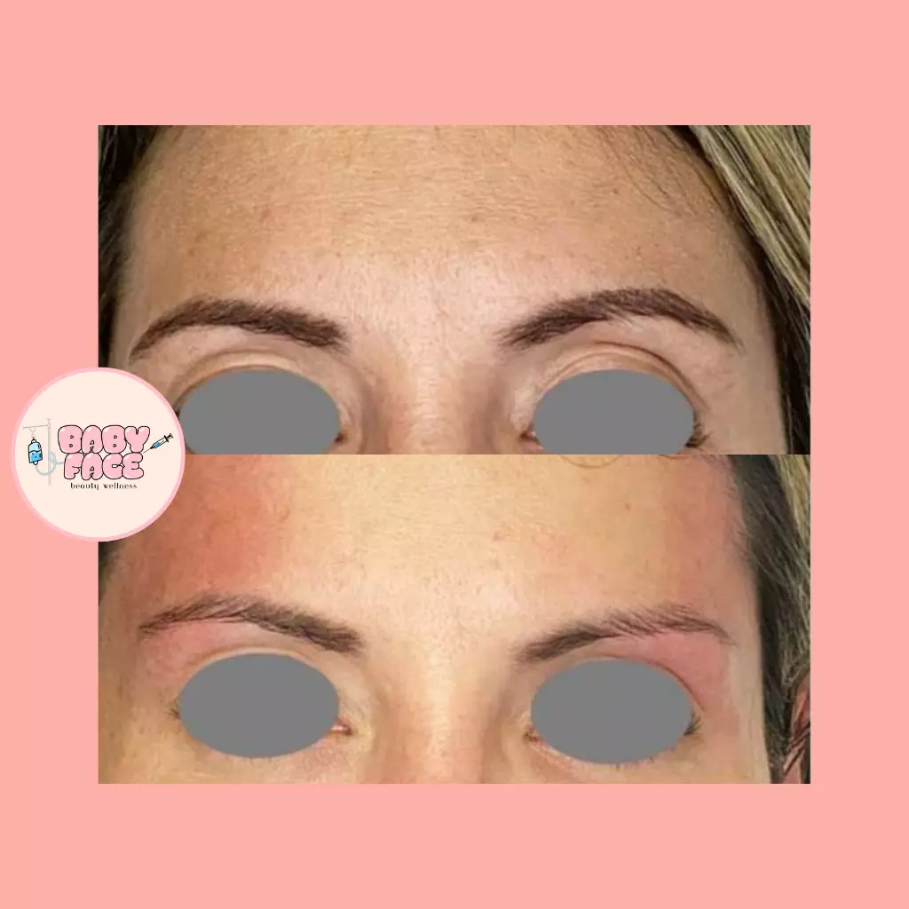 Before & After Fotona Laser Brow Lift